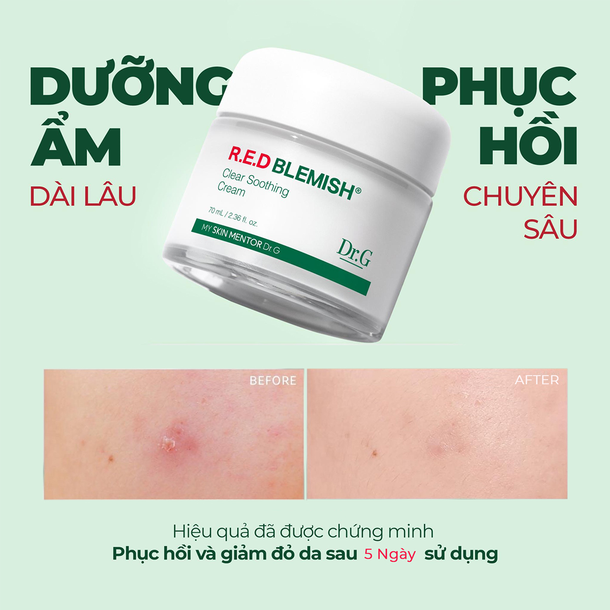 Kem dưỡng phục hồi cho da dầu mụn Dr G Blemish Clear Soothing Cream 70ml