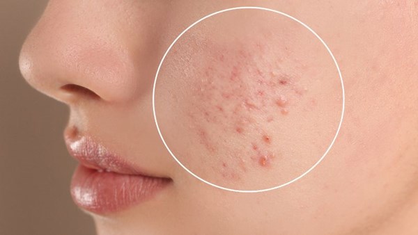 Bỏ túi các nguyên tắc vàng chăm sóc da mụn