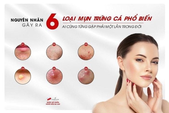 Nguyên nhân hình thành mụn và phương pháp cải thiện da mụn